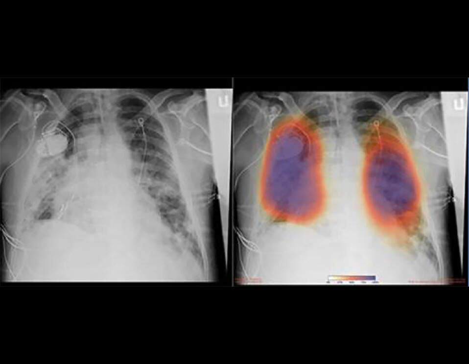 Chest X-rays from a patient with COVID-19 pneumonia, original x-ray (left) and AI-for-pneumonia result (right)