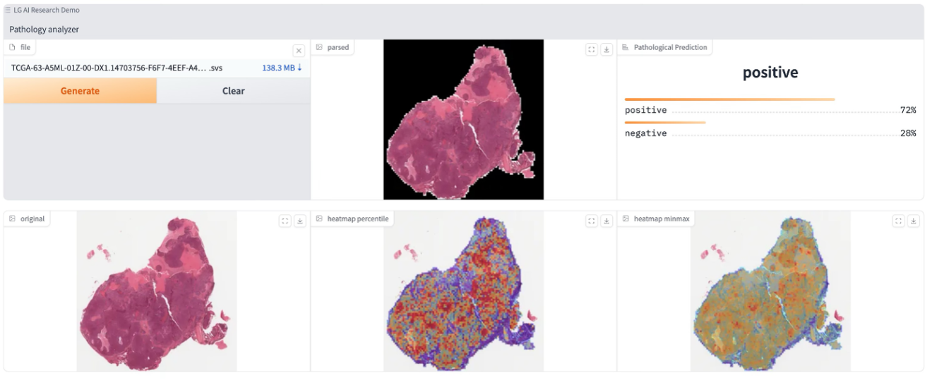 Histopathology images can be analyzed and visualized with EXAONEPath to identify possible genetic alterations within cells. Color variations can provide important clues about potential genetic alterations or abnormalities in the cells. Image credit: LG AI Research