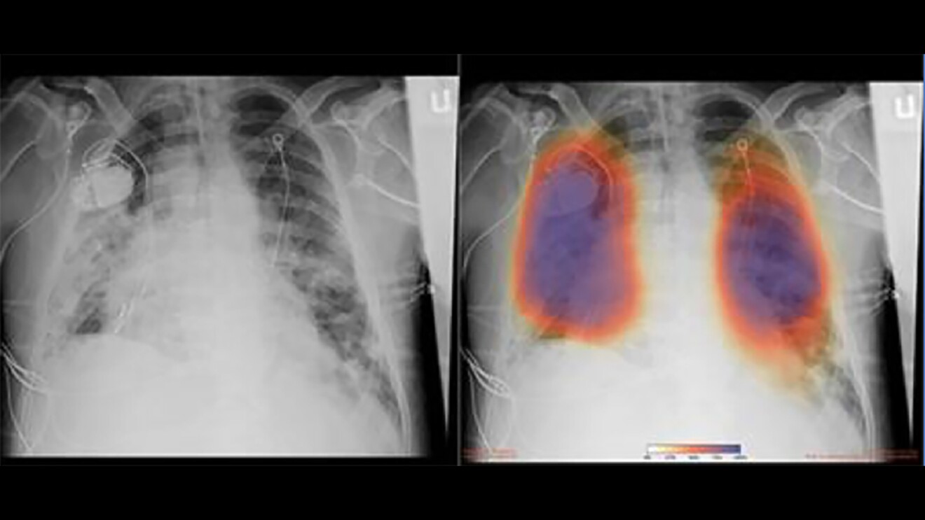 Chest X-rays from a patient with COVID-19 pneumonia, original x-ray (left) and AI-for-pneumonia result (right)