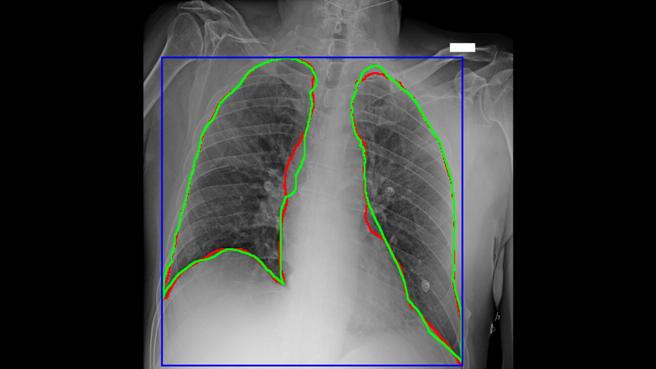 Radiografía de diagnóstico de un pulmón